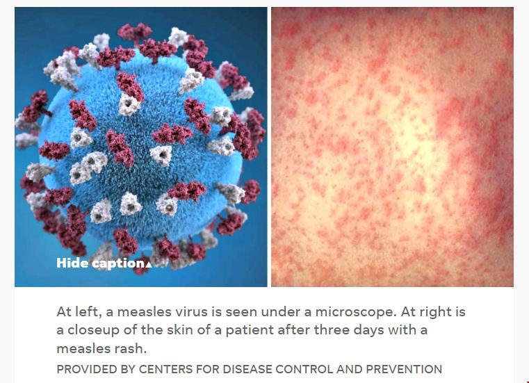 佐治亞大學聯(lián)合PSU研究出麻疹預測新模型.png 佐治亞大學聯(lián)合PSU研究出麻疹預測新模型.png